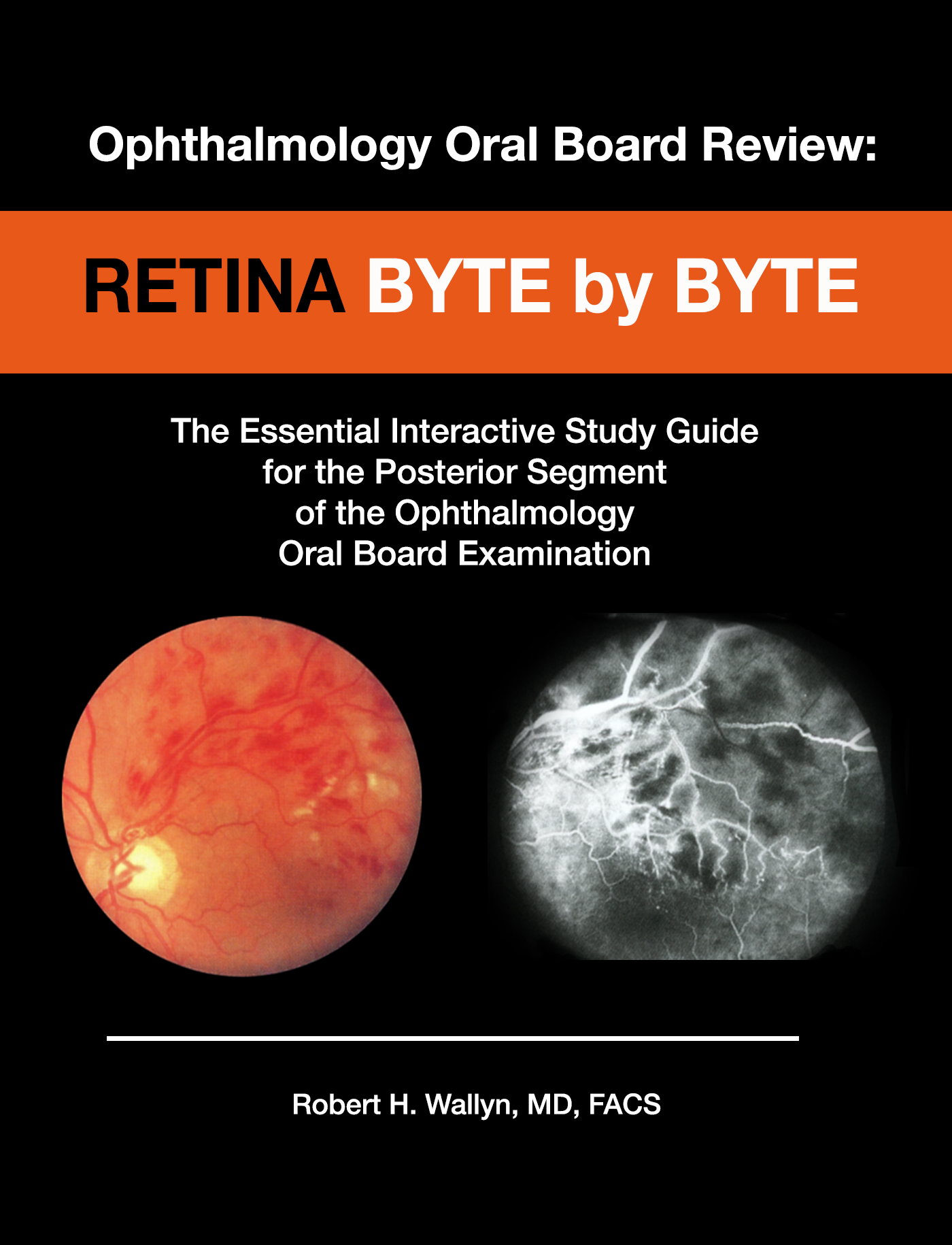 Retina: Byte by Byte by Robert H. Wallyn, MD, FACS